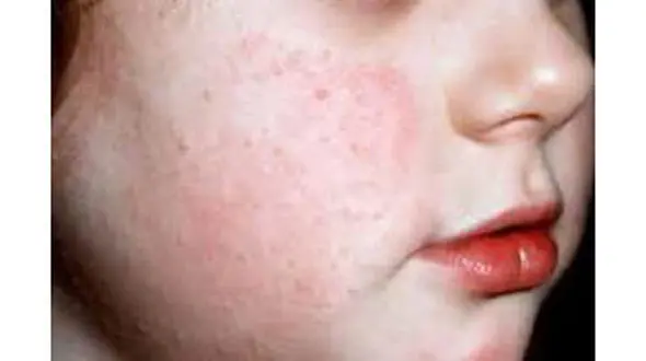 آشنایی و درمان بیماری پوست مرغی 