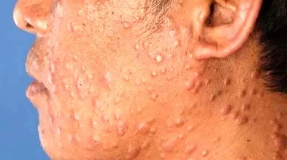 جذام هوز در ایران قربانی می گیرد