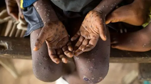 آبله میمون مثبت در ایران شناسایی نشده است  / فعلا برنامه ای برای خرید واکسن آبله نداریم