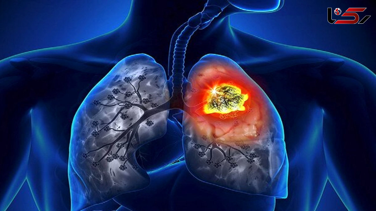 چطور سرطان ریه را خنثی کنیم؟