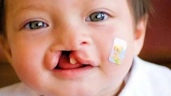 افزایش دو برابری ظرفیت درمان رایگان جراحی شکاف لب در لرستان/ مدیرعامل موسسه ملی مرهم خبر داد