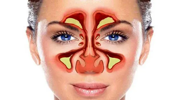 آلرژی عامل اصلی بروز سینوزیت