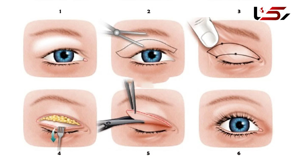  بلفاروپلاستی چیست؟ / روش انجام عمل بلفاروپلاستی + 6 جدول 