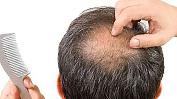 چرا مبتلایان کرونا دچار ریزش مو می شوند؟