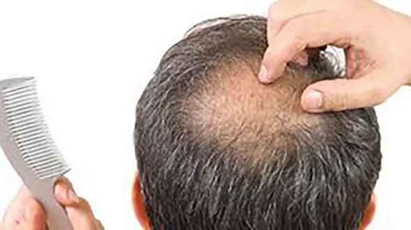 چرا مبتلایان کرونا دچار ریزش مو می شوند؟