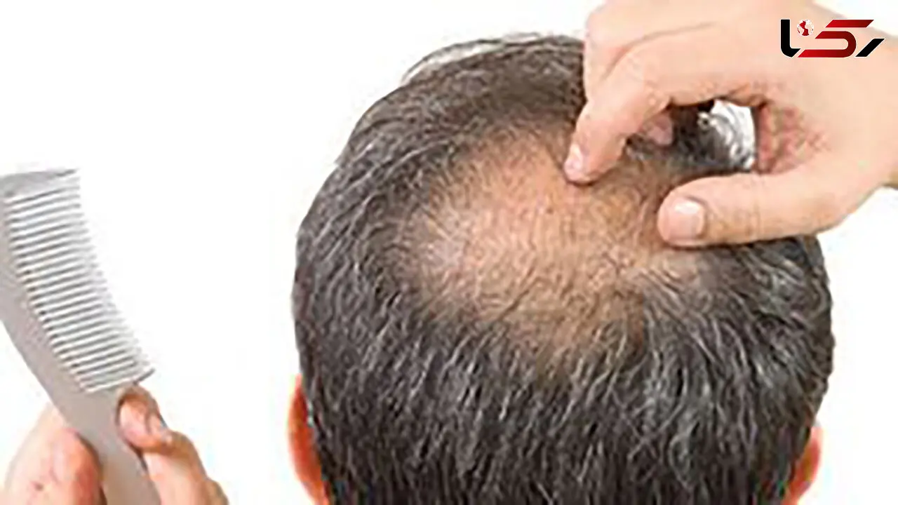 چرا مبتلایان کرونا دچار ریزش مو می شوند؟