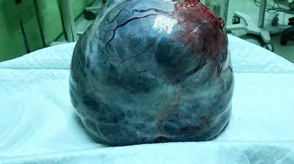 عکس عجیب / توده 6 کیلویی از شکم خانم اردبیلی خارج شد