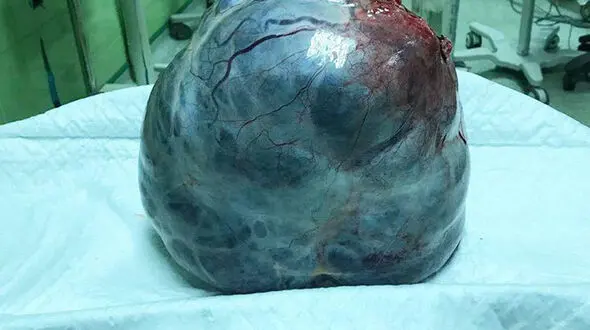 عکس عجیب / توده 6 کیلویی از شکم خانم اردبیلی خارج شد