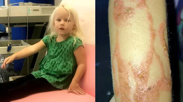 سوختگی دختر 3 ساله با تتو موقت+عکس