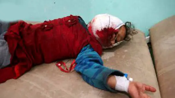 عکسی دلخراش از مجروحیت کودک یمنی در حمله مزدوران سعودی