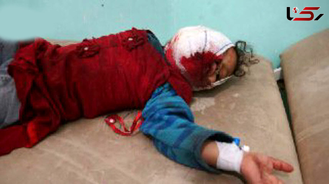 عکسی دلخراش از مجروحیت کودک یمنی در حمله مزدوران سعودی