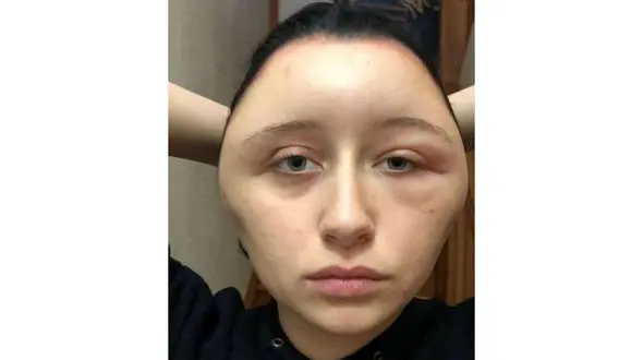 حادثه ای عجیب /دختر زیبا در یک شب زشت شد+ عکس وحشتناک