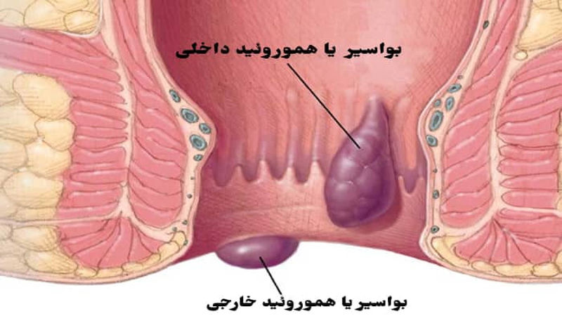 درد مقعدی