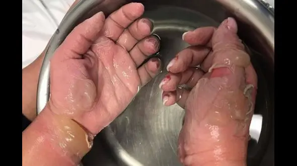 عجیب ترین دلیل کنده شدن پوست دستان دختر 19 ساله !+عکس