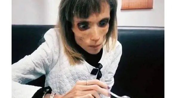 این دختر 26 ساله شبیه اسکلت شد+ عکس