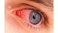 نانو اسفنج مانع از عفونت های چشمی می شود