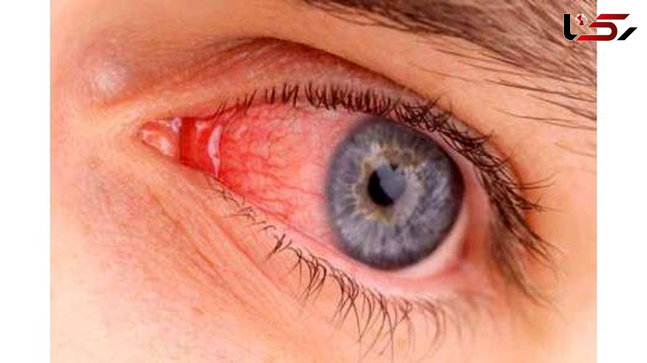 نانو اسفنج مانع از عفونت های چشمی می شود