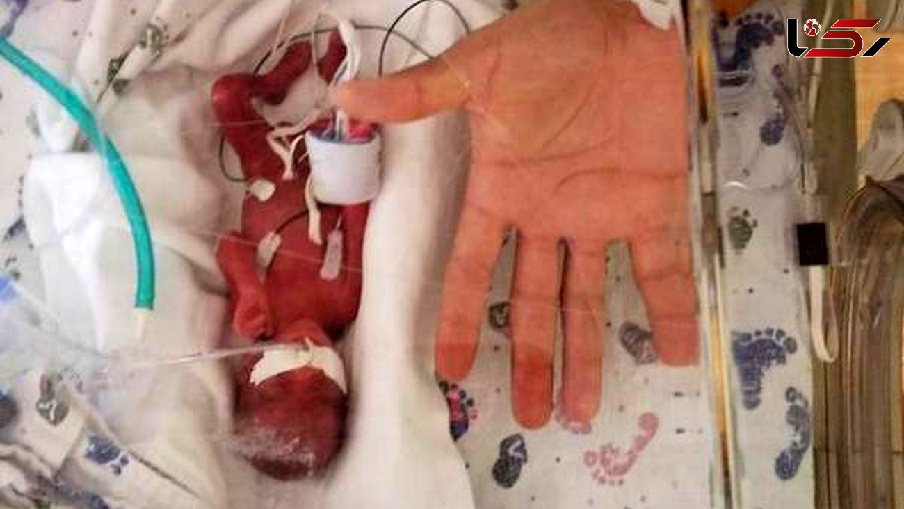 تولد نوزادی اندازه کف دست / همه شگفت زده شدند+عکس