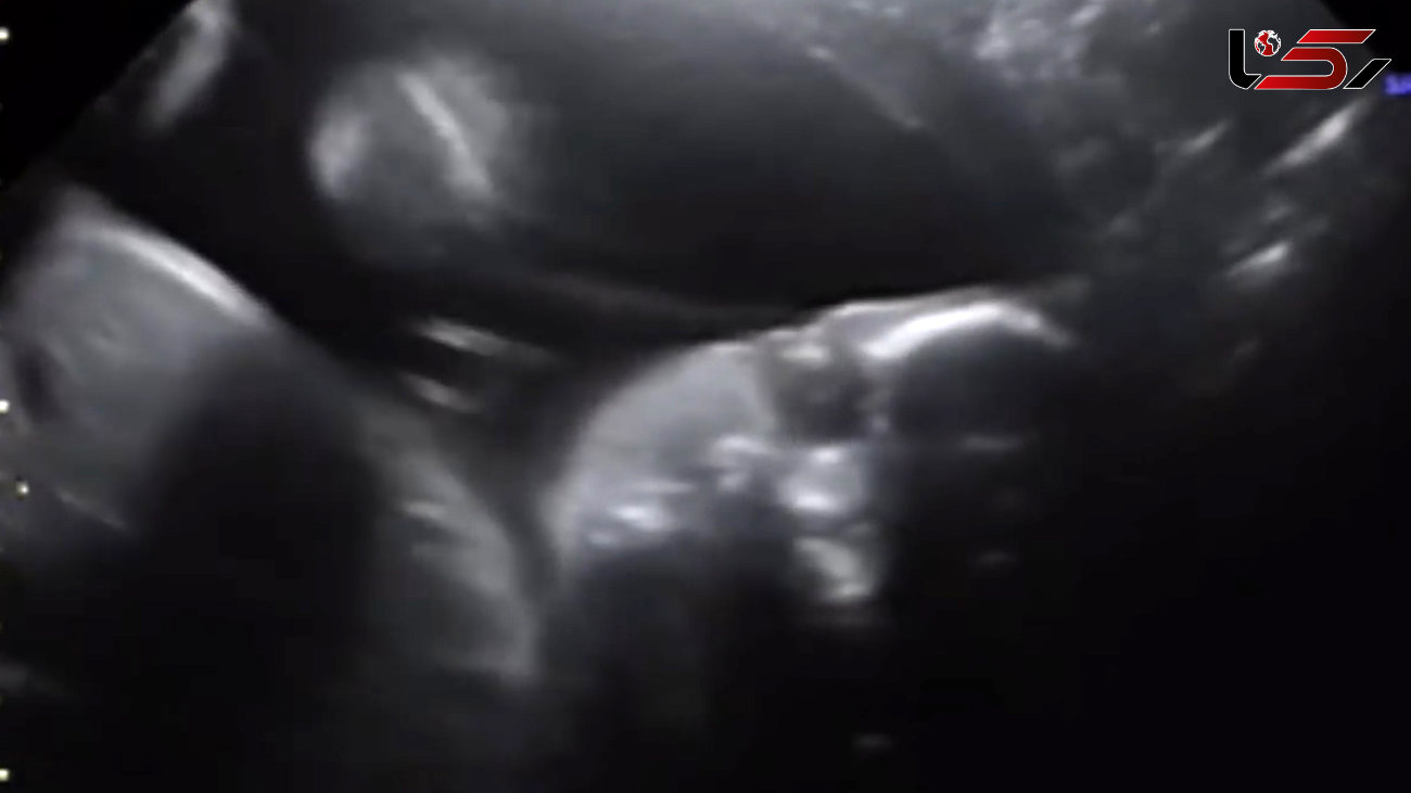 شیرین‌کاری جالب جنین برای والدینش هنگام سونوگرافی شکم مادرش+ فیلم