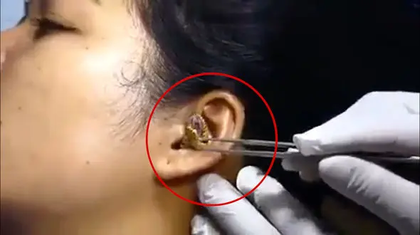 فیلم دلخراش از تلاش برای بیرون کشیدن مار زنده از گوش زن جوان  / ببینید