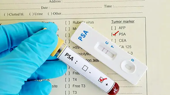 psa در آزمایش خون چیست؟ / دلایل افزایش سطح پی اس آ