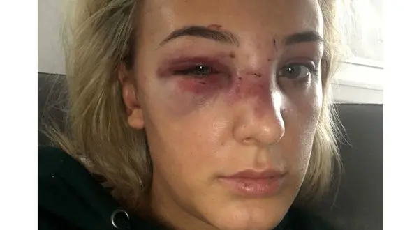 یک زن بدجوری کتک خورد و قهرمان شنا شد + عکس های صورت خونین