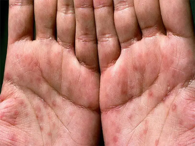 سوزاک