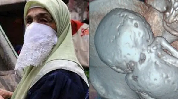 ماجرای جنین مرموز در شکم پیرزن75 ساله+عکس