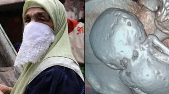 ماجرای جنین مرموز در شکم پیرزن75 ساله+عکس
