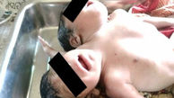 تولد نوزادی با 2 سر و 3 دست + عکس ها