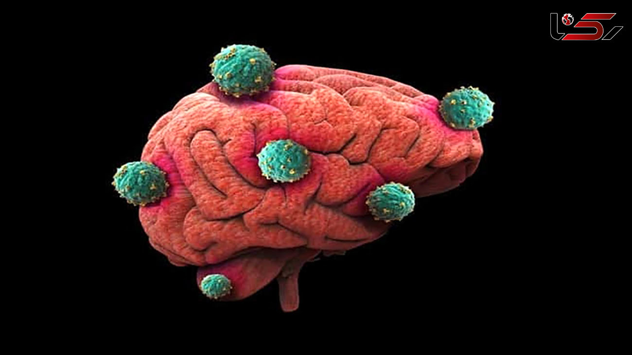 5 باور غلط درباره تومور مغزی