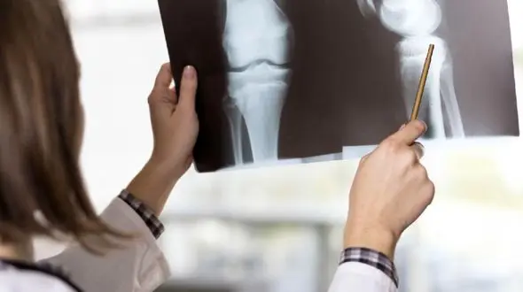 ارتباط شکستگی استخوان با مرگ زودرس