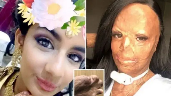 شامپوی ضد شپش دختر جوان را در حمام به آتش کشید+ عکس