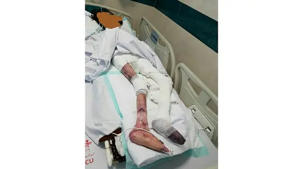 بدن تکه‌تکه و کرم‌زده «نفیسه»/ بیماری EB با دخترک چه کرد+عکس