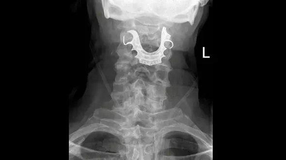 صحنه وحشتناکی که پزشکان داخل گلوی پیرمرد دیدند + عکس