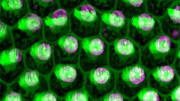 درمان ناشنوایی امکان پذیر شد