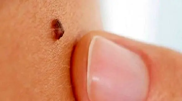 خال سرطانی چیست و چه نشانه‌هایی دارد؟