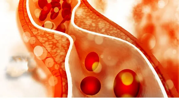 علائم چربی خون