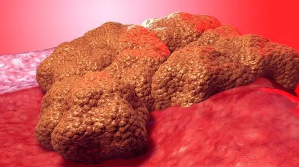 روشن شدن "کلید مرگ" سلول‌های سرطانی