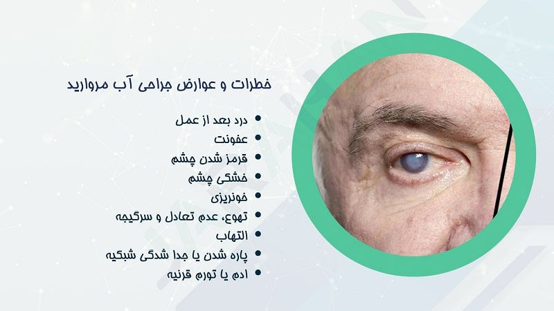 عوارض جراحی آب مروارید