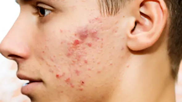 بهترین درمان های خانگی برای از بین بردن سریع جای جوش روی صورت