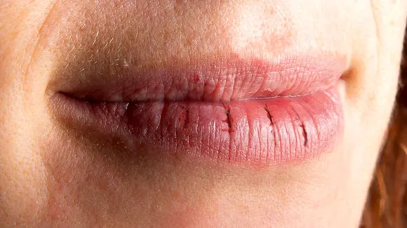 ماسک مخصوص لب های خشک 