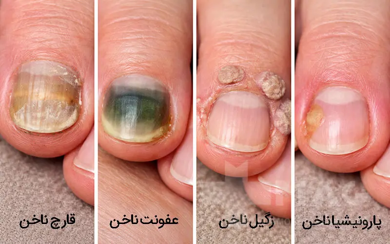 بیماری های ناخن (عفونت ناخن)