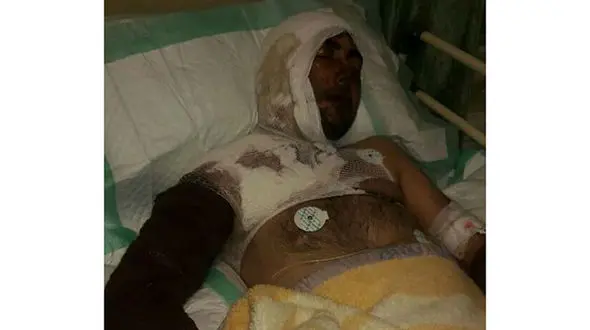 پدر سنگدل عروس و پسرش را قربانی اسیدپاشی کرد / در خلخال رخ داد+ عکس فجیع
