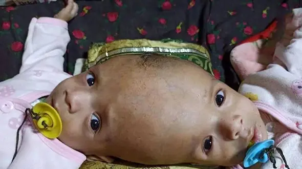 جراحی 15 ساعته برای جداسازی دوقلوها + عکس