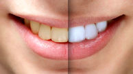 زیبایی دندان ها با بلیچینگ خانگی/ راه های سفید کردن دندان در خانه