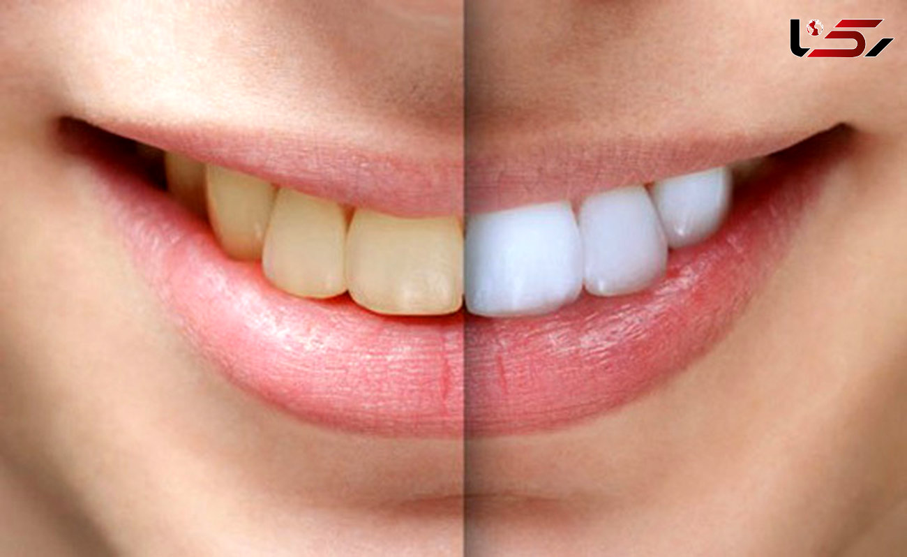 زیبایی دندان ها با بلیچینگ خانگی/ راه های سفید کردن دندان در خانه