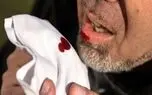 کاهش شناسایی بیماری سل در ایران در دوران کرونا / افراد علامت دار هرچه زودتر به مراکز درمانی مراجعه کنند
