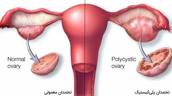 علت کیست تخمدان چیست؟
