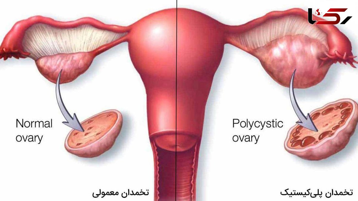 علت کیست تخمدان چیست؟